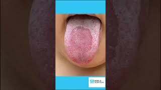 Treatment for Geographic Tongue and 4 Best Practices [upl. by Nosirrag95]