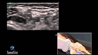 How To Ultrasound Guided Popliteal Sciatic Nerve Block 3D Video [upl. by Alfred]