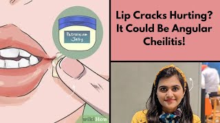 Lip Cracks Hurting It Could Be Angular Cheilitis [upl. by Hennessey]