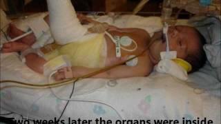 From Gastroschisis to Autism [upl. by Kho]