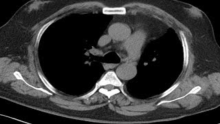 Cross sectional and imaging anatomy of the thorax [upl. by Inohtna]