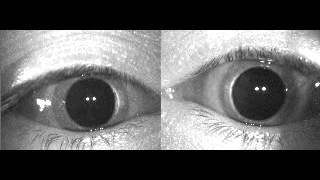 Verticalrotatory geotropic nystagmus in right pBPPV Canalolithiasis [upl. by Rep]