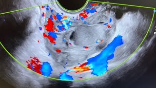 Ultrasound of acute salpingitis thick vascular fallop tube endometriotic simple amp nabothian cyst [upl. by Lange]