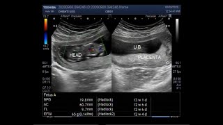 Ultrasound Video showing Placenta Previa [upl. by Rakel]