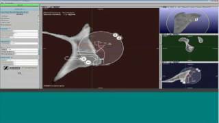 Preoperative virtual planning of the glenoid component implantation [upl. by Ykroc]