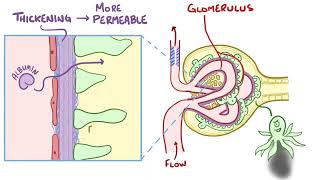 Diabetic Nephropathy  Osmosis [upl. by Aihppa]