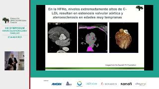 Hipercolesterolemia Familiar Homocigota Actualización en el diagnóstico y tratamiento [upl. by Thorman642]