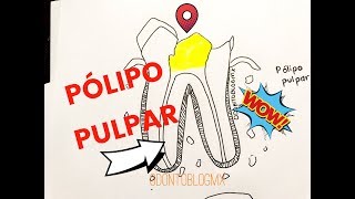 Pulpitis Hiperplásica ó Pólipo pulpar [upl. by Caleb]