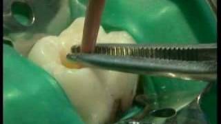 Endodontie mécanisée le système PROTAPER® principes et guide dutilisation [upl. by Castara]