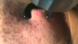 relissage resurfacing sur acné cicatrices peeling lasermp4 [upl. by Elocan]