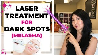 Laser Treatment for Dark Spots Melasma [upl. by Yneffit125]