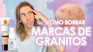 COMO BORRAR MARCAS DE ACNE de manera rápida y segura [upl. by Yllas861]