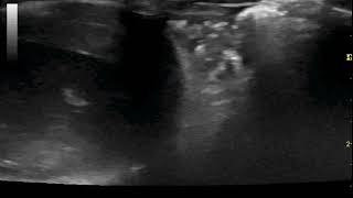 Lung ultrasound in FIP [upl. by Annaed]