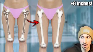 This Surgery Will Make You 6 Inches Taller limb lengthening surgery [upl. by Berwick]