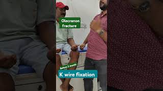 olecranon fracture with k wire fixation [upl. by Annahsirhc]