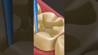 tooth filling procedure STEP BY STEP teeth colour filling teethfilling asmr implantprocedure [upl. by Lennaj876]