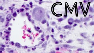 CMV cytomegalovirus infection in skin ulcer pathology dermpath dermatology dermatopathology [upl. by Amice]