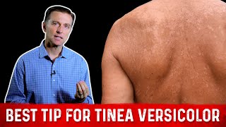 Natural Skin Fungus Tinea Versicolor Home Remedies – Dr Berg [upl. by Driskill682]