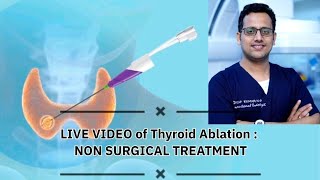 Live Video of Thyroid Ablation  Non Surgical treatment [upl. by Marilou]