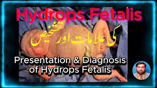 Presentation and Diagnosis of Hydrops Fetalis کی علامات اور تشخیص Hydrops Fetalis [upl. by Dylana783]