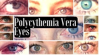 MPN Polycythemia Vera Blood Shot Red Eye Manifestations [upl. by Marsiella]