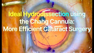 IDEAL Hydrodissection with the Chang Cannula for EFFICIENT cataract surgery Shannon Wong MD [upl. by Aneral560]