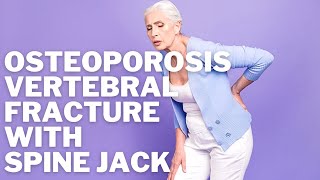 Osteoporosis Lumbar Vertebral Spine Compression Fracture causing back Pain Spine Jack Kyphoplasty [upl. by Donni794]