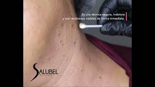 ✨ Eliminación de Verrugas amp Manchas con Fibroblast ✨ [upl. by Wallinga]