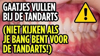 Gaatjes Vullen Bij De Tandarts  Filling Cavities At The Dentist ENG SUBS [upl. by Tiemroth]