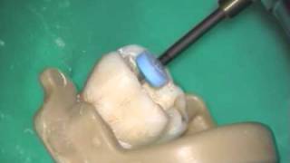 BioRaCe Retreatment  Molar [upl. by Ledoux543]