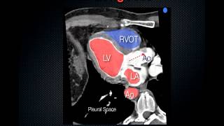 FATE Exam Focused Assessed Transthoracic Echo [upl. by Jayme884]