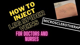 How to Inject Leg Spider Veins and Blue Veins by Microsclerotherapy  5 Tips for Doctors and Nurses [upl. by Hallagan]