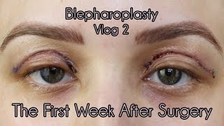 My Eyelid Surgery 1st Weeks of Recovery  Cosmetic Blepharoplasty Diary Part 2 [upl. by Dumas]