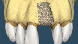 Implantes Dentários  Com Enxerto Ósseo [upl. by Twelve]