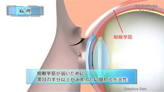 眼瞼下垂／2分で分かる医療動画辞典 ミルメディカル [upl. by Arela874]