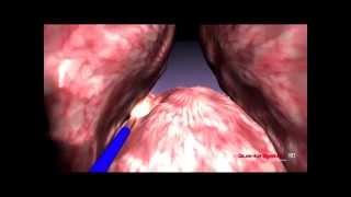 Quanta System  BPH  3D Enucleation median lobe  Thulium Laser [upl. by Bronez954]