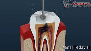 Kanal Tedavisi Nasıl Yapılır  Endodonti [upl. by Rojas818]