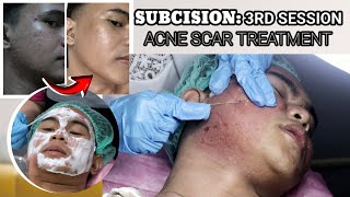 THIRD SESSION SUBCISION FOR ACNE SCARS  3 IN 1 SYNERGISTIC ACNE SCAR TREATMENT  3RD SESSION [upl. by Trahern]