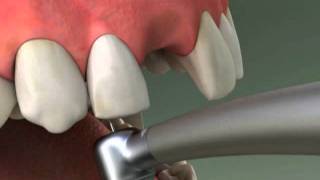 Dentist  Maryland Bridge Procedure [upl. by Bluhm719]