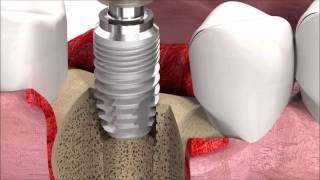 SIC invent Dental Implant Procedure SICmax implant insertion [upl. by Ylicis740]