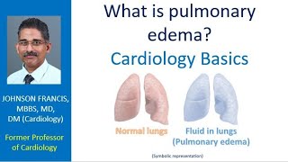 What is pulmonary edema Cardiology Basics [upl. by Bores]