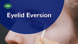 Eyelid Eversion [upl. by Wini]