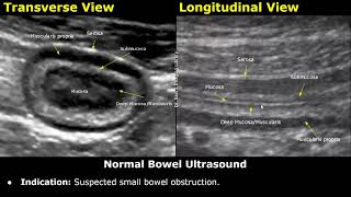 Small Bowel Ultrasound Reporting  How To Write USG Report  Bowel Obstruction Crohns Disease [upl. by Estella166]