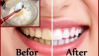 DIY Teeth Whitening at Home in 2 minutes [upl. by Atsirak]