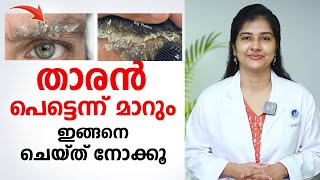 താരൻ പെട്ടെന്ന് മാറും ഇങ്ങനെ ചെയ്താൽ  Dandruff Treatment at Home  DrRadhika SBhat [upl. by Yna]