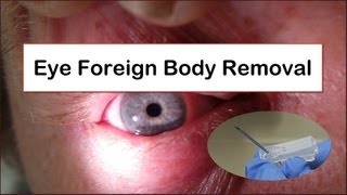 Eye Foreign Body Removal [upl. by Sapphira]