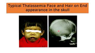 Beta Thalassemia and Alpha Thalassemia  Types Diagnosis and Treatment  Thalassemia Major amp Minor [upl. by Forcier659]