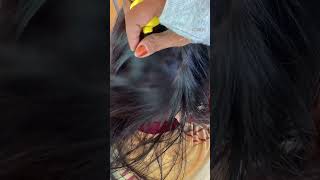 Thousand lice giant girl Head 😲 lice treatment nitsremoval headliceremoval liceremoval [upl. by Belmonte]