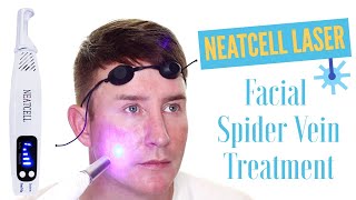 Neatcell Picosecond Laser Spider Vein Treatment  TJtutorials [upl. by Ynoffit10]