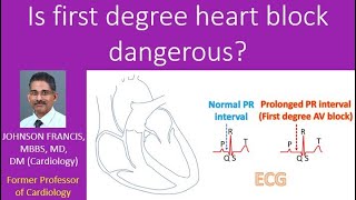 Is first degree heart block dangerous [upl. by Wilma31]